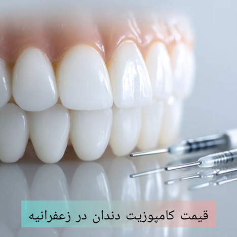 قیمت کامپوزیت دندان در زعفرانیه