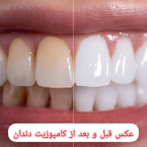 عکس کامپوزیت دندان قبل و بعد