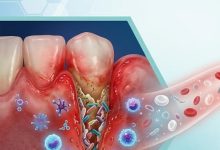 باکتری بیماری لثه چگونه می‌تواند به دریچه قلب آسیب برساند؟