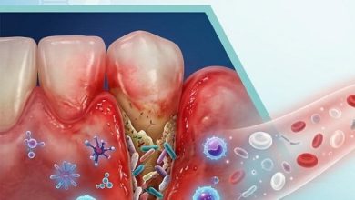 باکتری بیماری لثه چگونه می‌تواند به دریچه قلب آسیب برساند؟