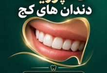 کامپوزیت دندان های کج در کلینیک دندانپزشکی ایرانادنت مشهد