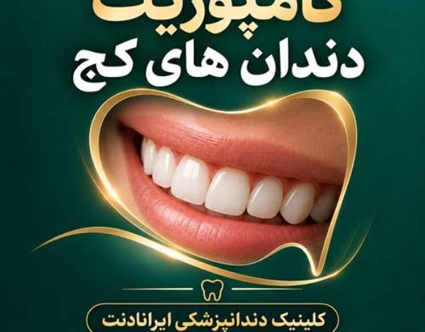 کامپوزیت دندان های کج در کلینیک دندانپزشکی ایرانادنت مشهد